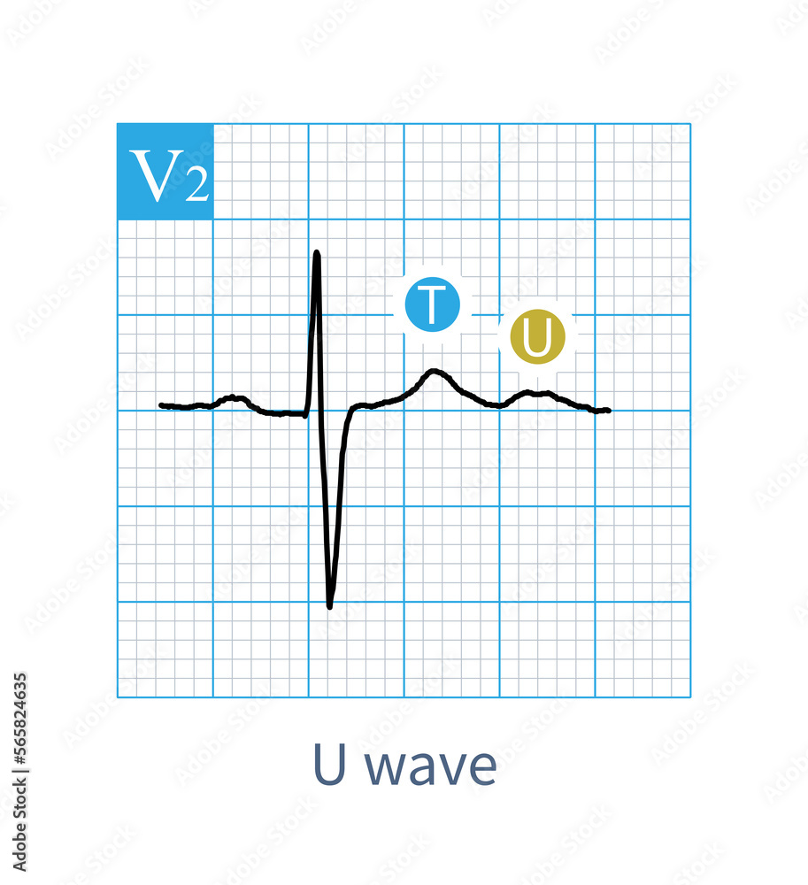 Stockillustratie On ECG U Wave Is A Low Wave After T Wave And Its interview-thank-you-template