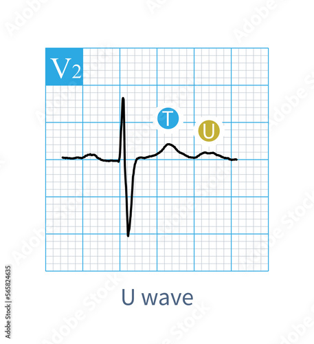 On ECG, U wave is a low wave after T wave, and its mechanism is still unclear. It may be an electromechanical feedback wave.It is easy to recognize when the heart rate is slow.