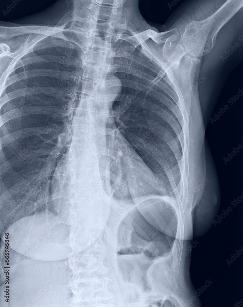 Costal x-ray of coast sternum and clavicle Costal x-ray of coast sternum and clavicle
