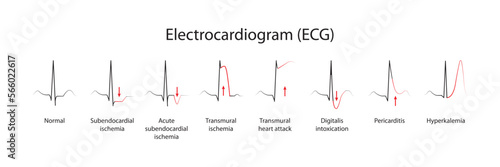 Interpretation of the electrocardiogram (ECG) photo