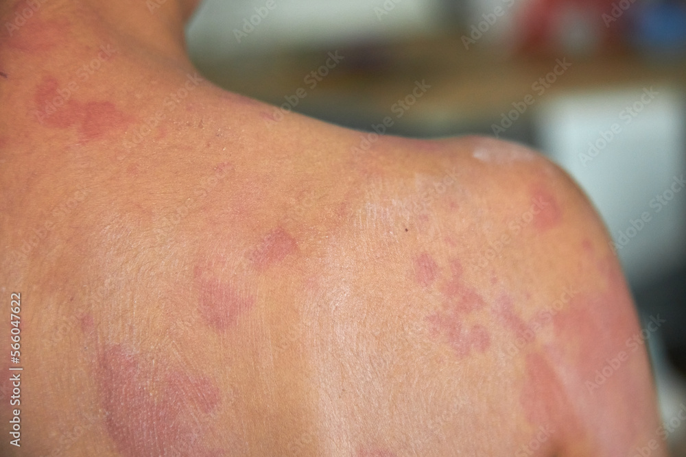 Fototapeta premium Itchy skin, dermatitis, food allergies. Baby showing her back with acne, red spots. Baby's having itching, scratching her body with allergy rash