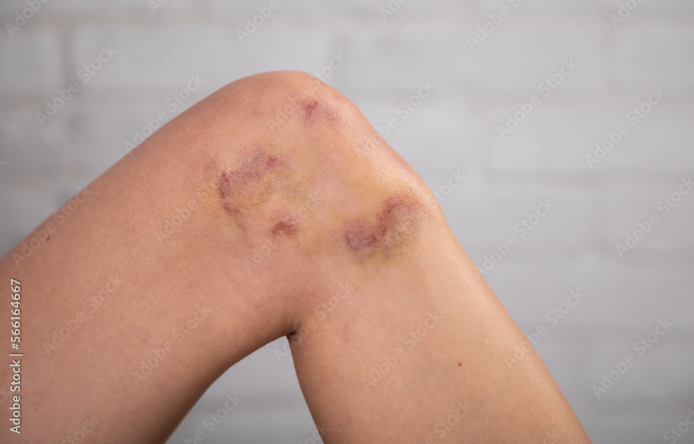 Close up of stain bruise wound on leg, contusion young woman, girl on joint knee from an accident fell down, hand in healing injury by massage hematoma blood Close up of stain bruise wound on leg, contusion young woman, girl on joint knee from an accident fell down, hand in healing injury by massage hematoma blood