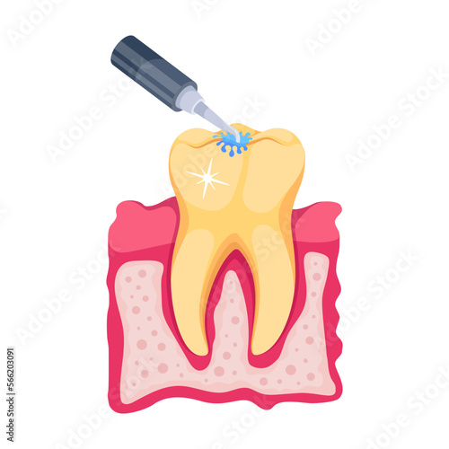 Root Canal