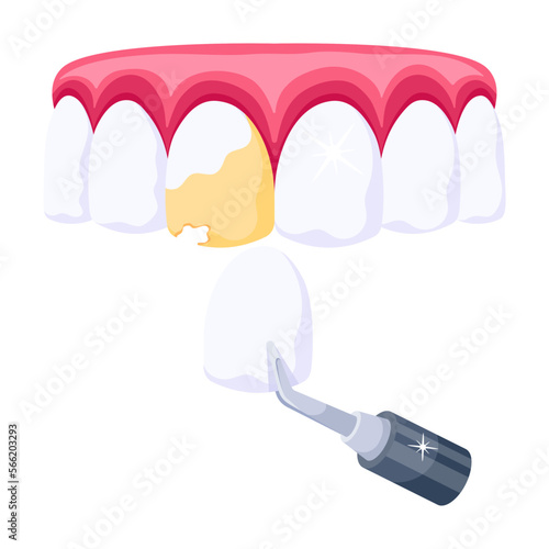 Veneers 