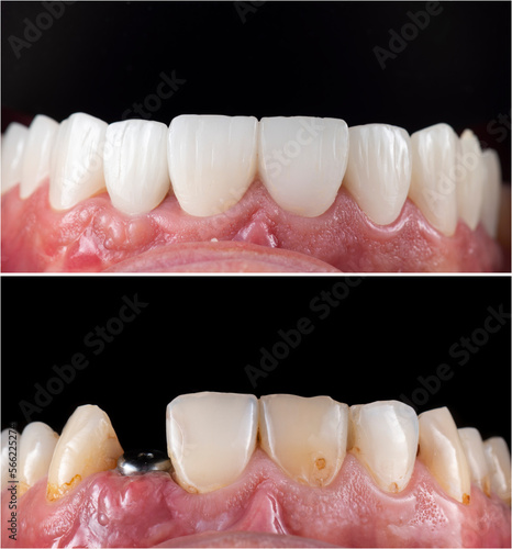 emax ceramic crowns and veneers