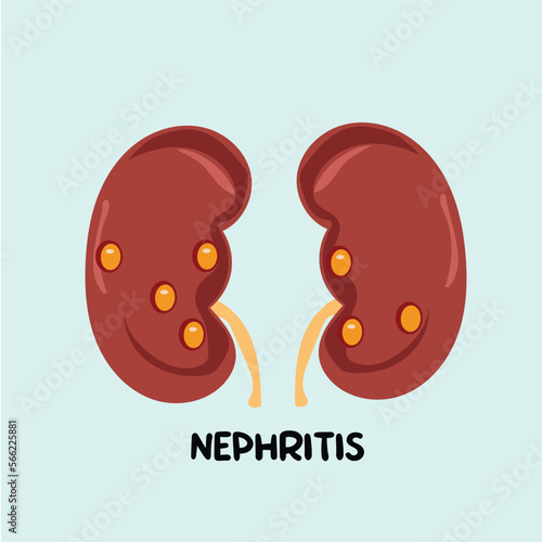 kidney nephritis illustration vector photo