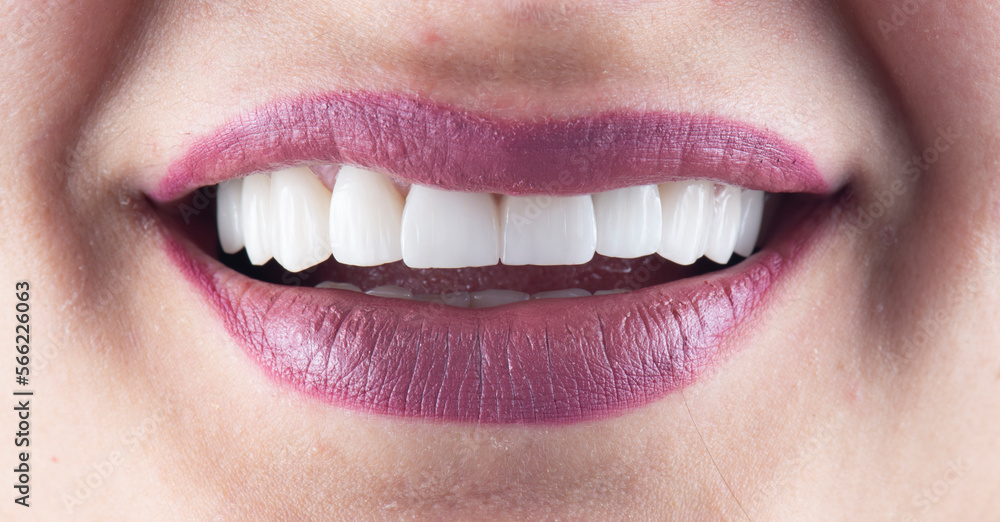 emax ceramic crowns and veneers emax ceramic crowns and veneers