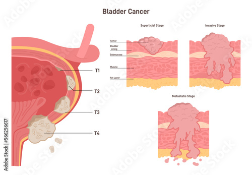 Stages of bladder cancer. Human internal organ wall with a developing