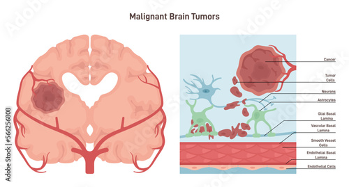 Brain cancer concept. Malignant tumor develops in the human brain.