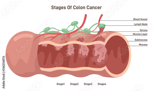 Colon cancer. Stage of development of a malignant tumor in human