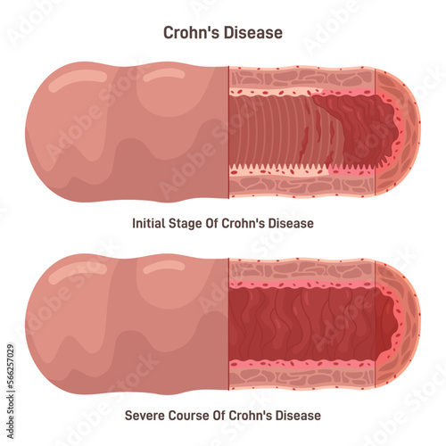 Crohn's disease. Chronic, or long-term inflammatory bowel disease. photo