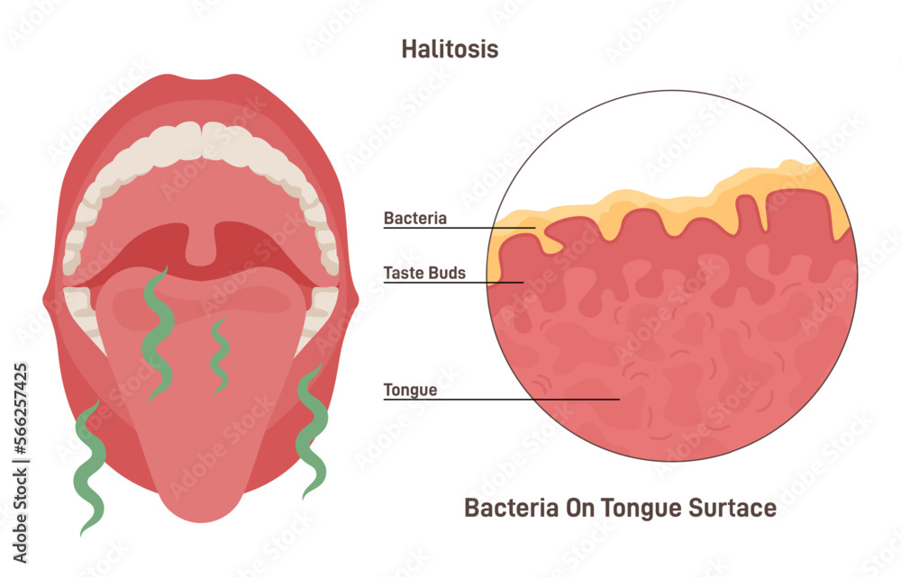 Oral hygiene concept. Halitosis, chronic bad stinky breath, bacterial - obrazy, fototapety, plakaty 