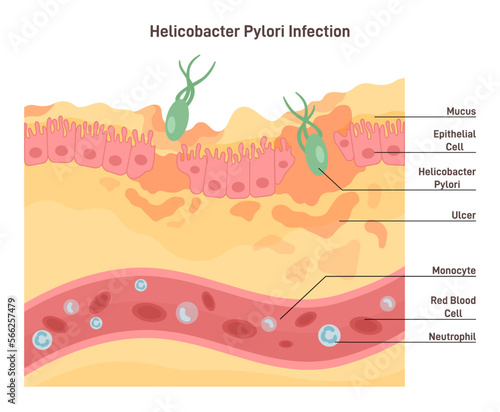 Helicobacter pylori infection. Bacterium with flagella damage the tissue photo