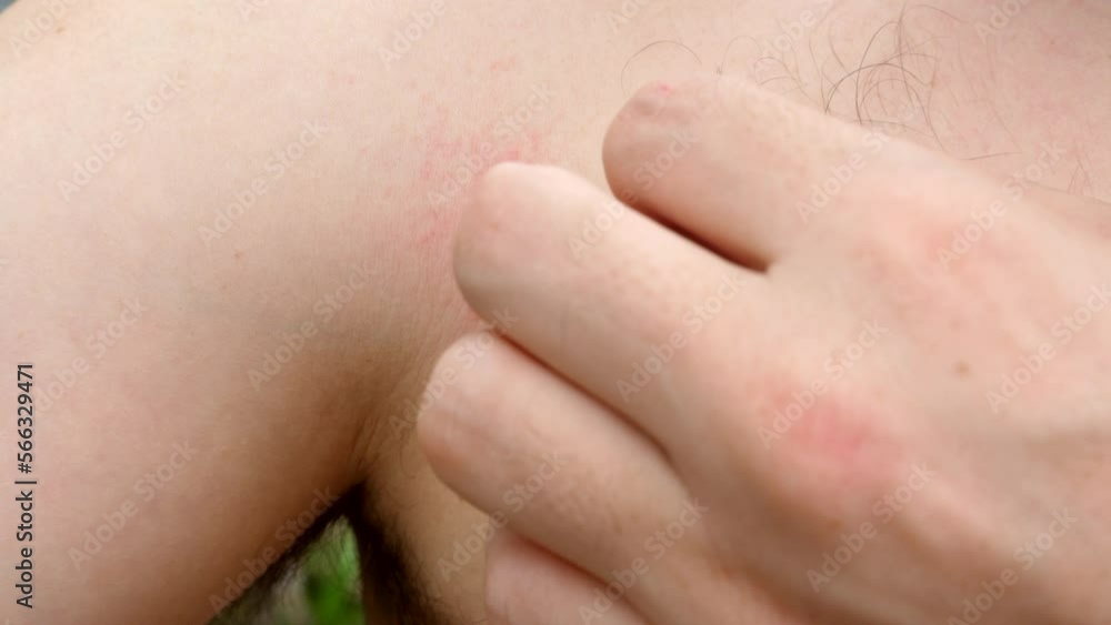 Mosquitoes leave their mark on man chest, causing bumps to form on skin Mosquitoes leave their mark on man chest, causing bumps to form on skin