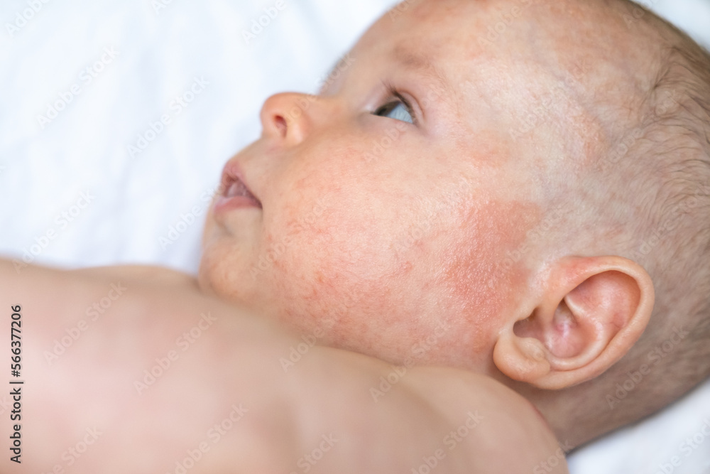 a baby boy face with red irritated marks near left ear and cheek