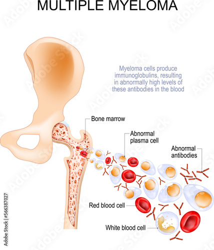 Multiple myeloma