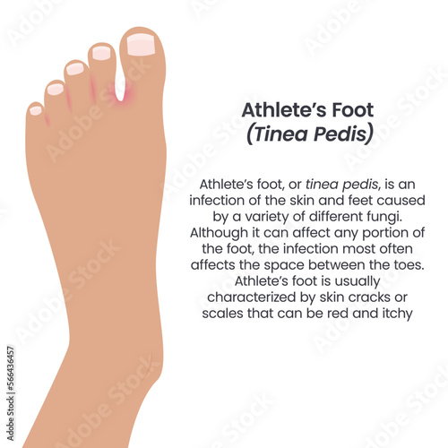 Athlete's Foot Tinea Pedis vector illustration vector infographic