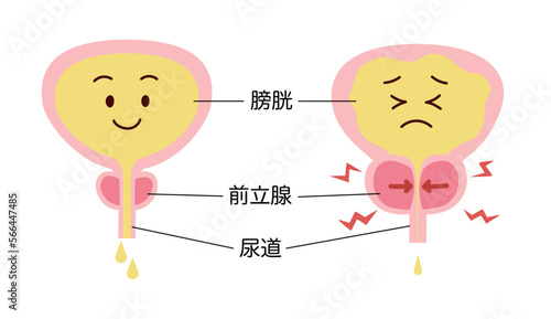 正常と前立腺肥大の比較説明イラスト