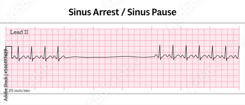 ECG Sinus Arrest - Sinus Pause - 8 Second ECG Paper - Vector Medical Illustration