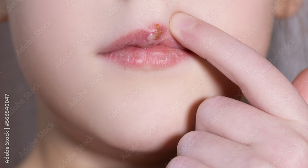 Obraz premium Children's herpes virus on the lip of a sick girl. The child points a finger at the wound on the upper lip. Close-up of the disease