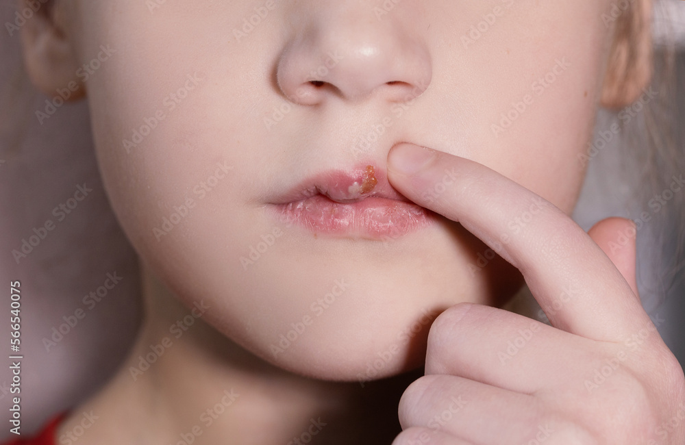 Fototapeta premium Children's herpes virus on the lip of a sick girl. The child points a finger at the wound on the upper lip. Close-up of the disease