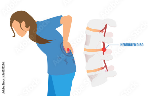 Vector of a woman with a low back pain and sciatica from a herniated disc.
