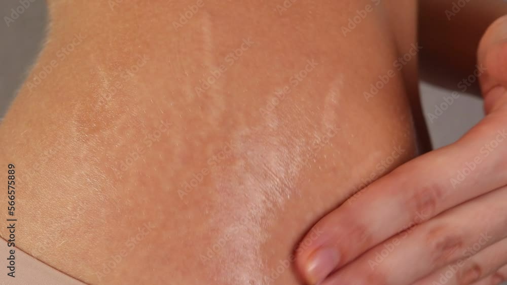 Stretch marks on a womans hips. Cream for skin stretching Stretch marks on a womans hips. Cream for skin stretching