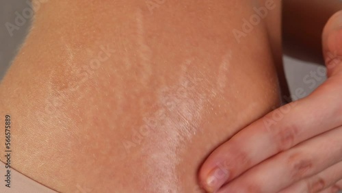 Stretch marks on a womans hips. Cream for skin stretching photo