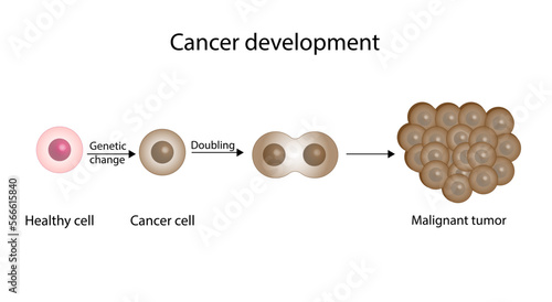 Process of cancer cell development. Cancer disease development. Malignant tumor. Medical biological, science vector illustration. photo