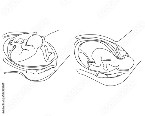 Giving birth.Vaginal delivery and c-section icons,emblem,poster design template Line art vector illustration, icons, vector illustration.Fetal position inside the womb liner black and white drawing