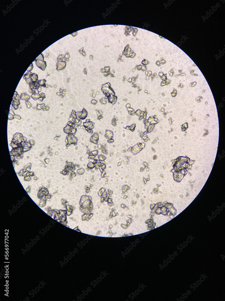 Microscopic view of struvite crystals from urinary sediment. Magnesium
