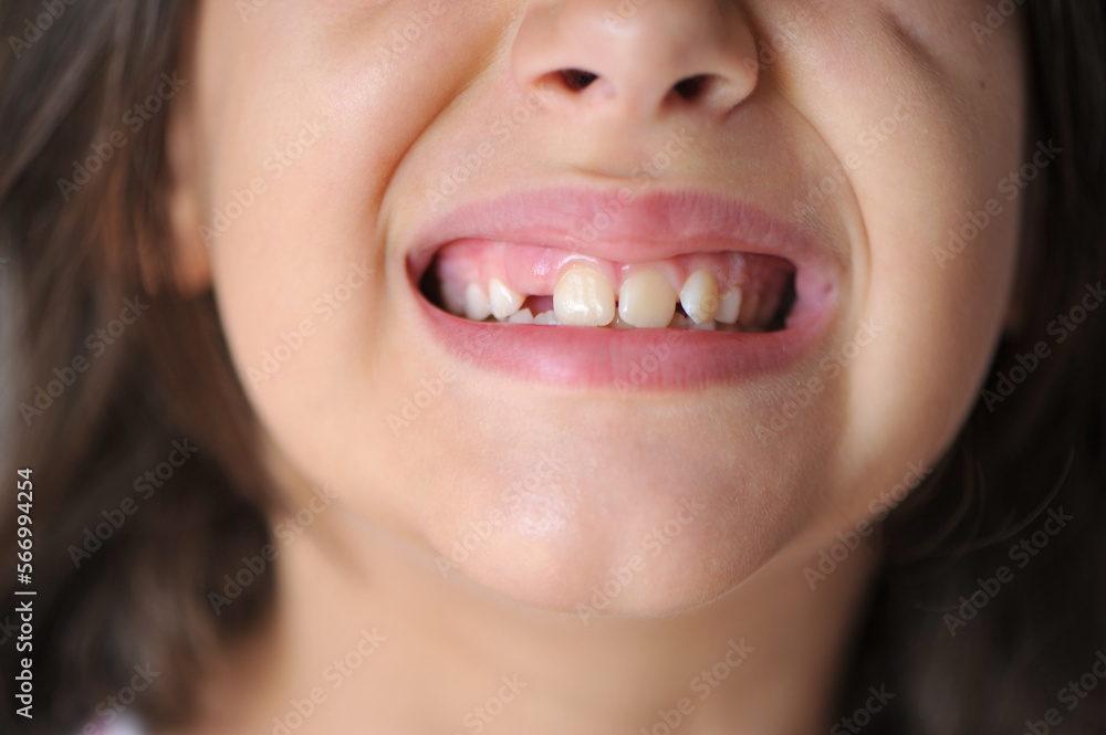 boca com dentes falhando um dente, odontologia infantil boca com dentes falhando um dente, odontologia infantil