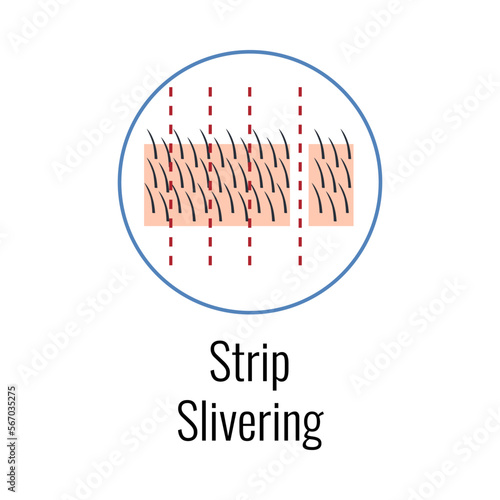 Alopecia Strip Silvering Composition