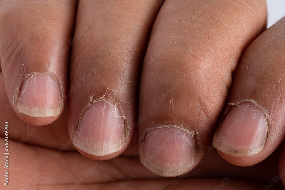 Close up of fingers with dry, cracked skin on cuticles, skin is torn