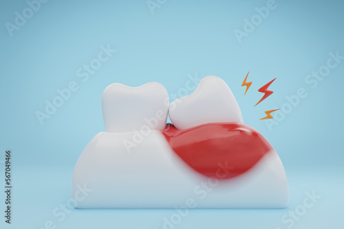 Canvas Print Gums and teeth disease wisdom tooth infection on blue background