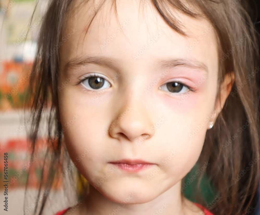 Child with red swollen eye from insect bite. Quincke edema. Sick body ...