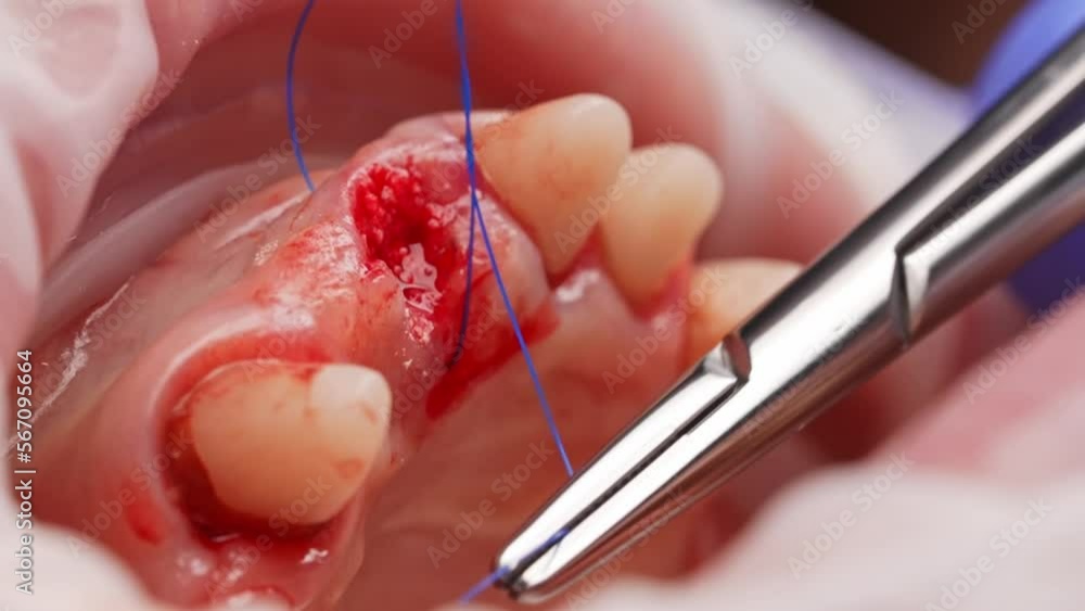 Operation on the teeth. The orthodontist puts stitches on the gum after surgery on a sleeping patient. Inflamed jaw with blood. Operation on the teeth. The orthodontist puts stitches on the gum after surgery on a sleeping patient. Inflamed jaw with blood.