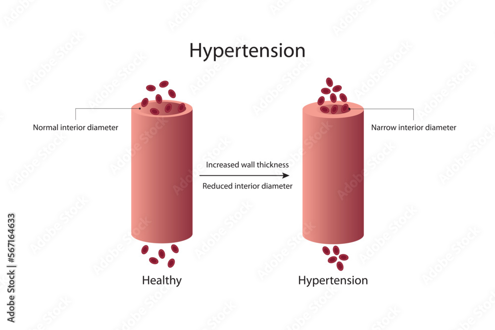 Hypertension. Healthy and vessel with hypertensive. Hypertension. Healthy and vessel with hypertensive.