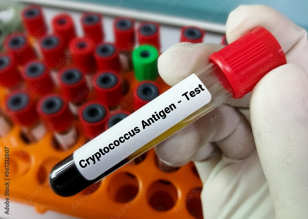 Obraz premium Blood sample for Cryptococcus Antigen test.