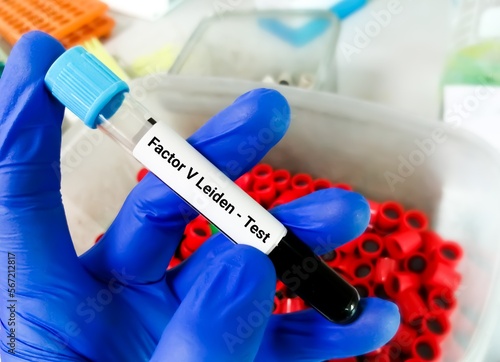 Blood sample for Factor V Leiden test, a mutation of clotting factors in the blood which may increase the chance of developing abnormal blood clots, most commonly in legs and lung. photo