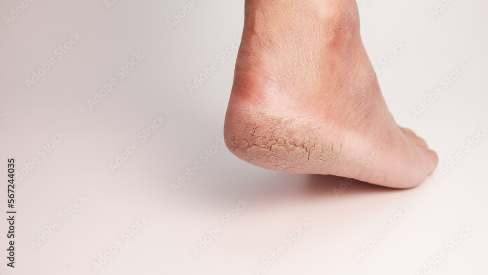 Fototapeta premium Dry cracked heels on white background