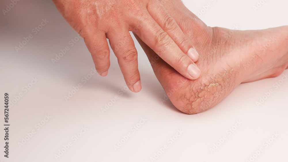 Fototapeta premium Dry cracked heels on white background