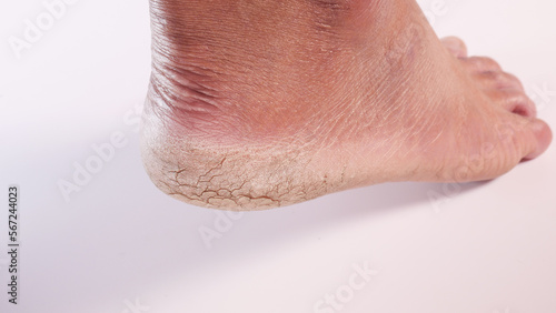 Dry cracked heels on white background
