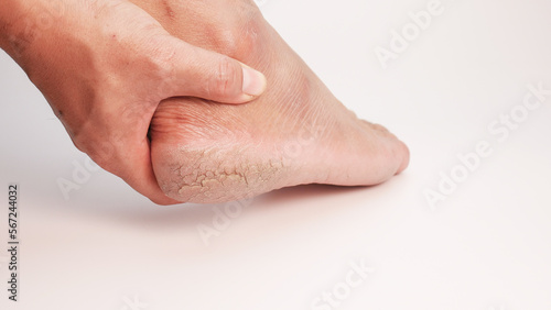 Dry cracked heels on white background