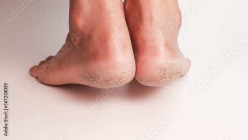 Dry cracked heels on white background