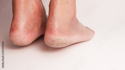 Dry cracked heels on white background