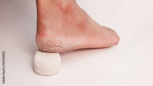 Dry cracked heels on white background