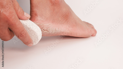Dry cracked heels on white background