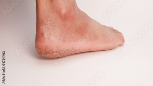 Dry cracked heels on white background