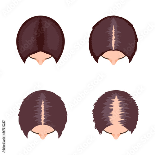 Female Alopecia Stages Composition